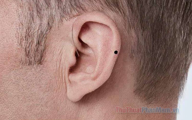 Nốt ruồi ở tai có ý nghĩa gì? Tốt hay xấu?