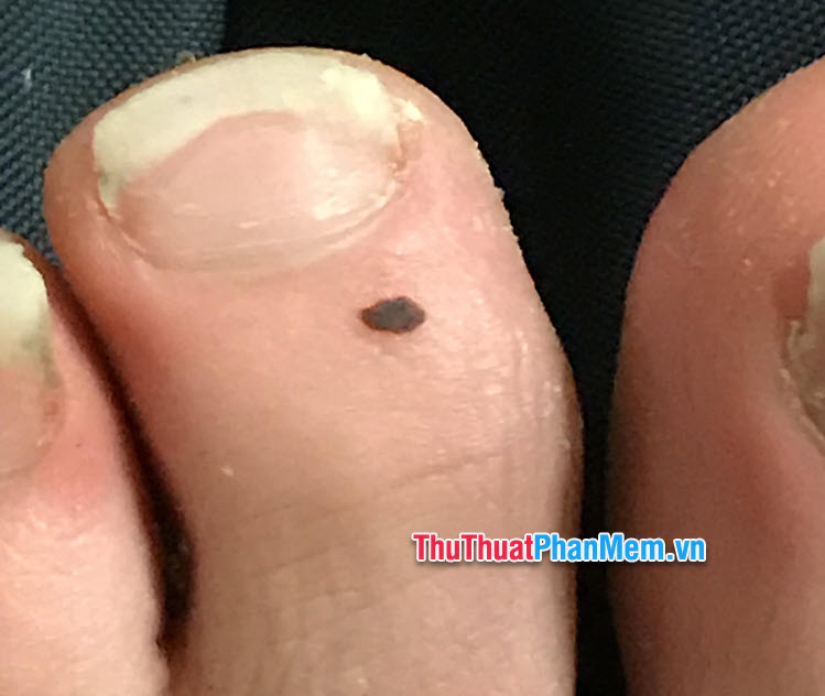 Nốt ruồi ở ngón chân